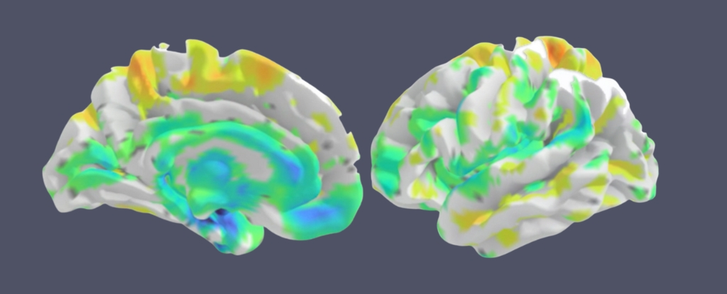 Degeneration in LANS is seen in distinct brain areas.