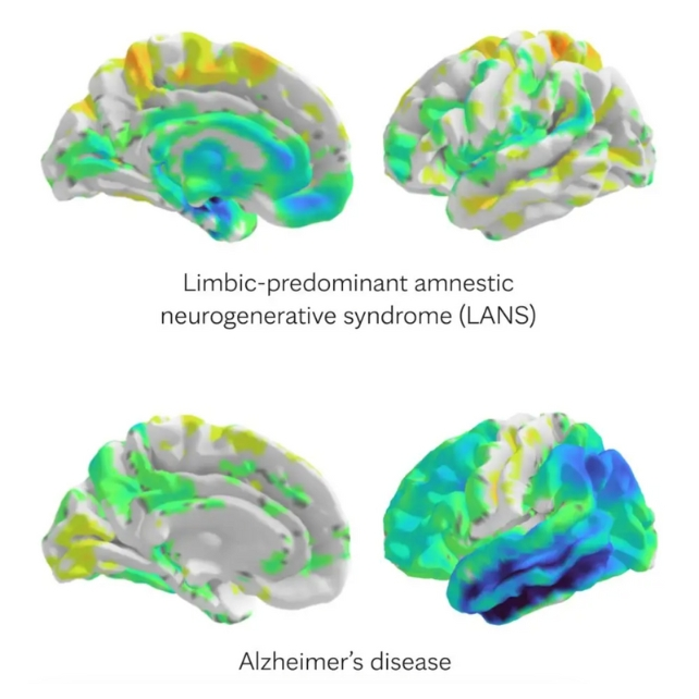 Notable differences include degeneration in distinct brain areas, indicated in cool colors