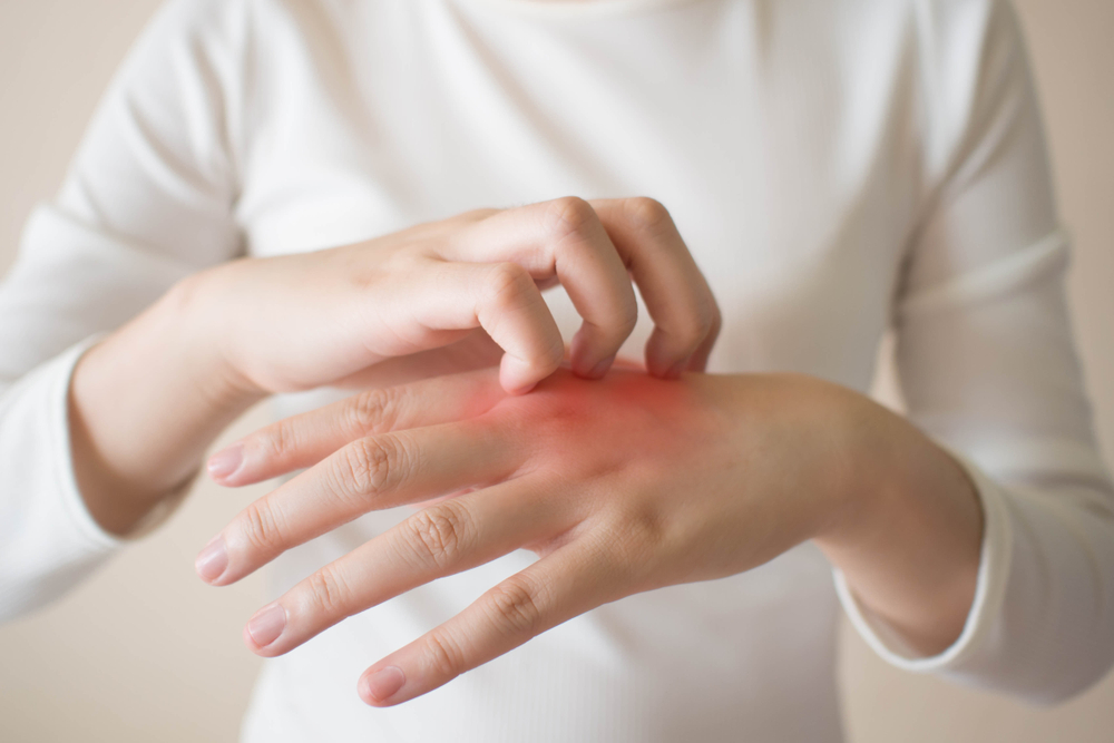 Young woman scratching the itch on her hands w/ redness rash. Cause of itchy skin include dermatitis (eczema), dry skin, burned, food/drugs allergies, insect bites. Health care concept. Close up.