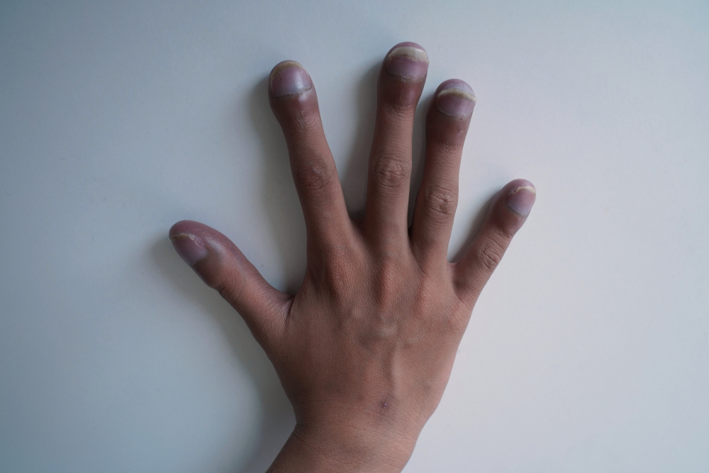 Right hand of patient with congenital cyanotic heart disease on white background. Typical characteristic for clubbing fingers. Focus on fingers.