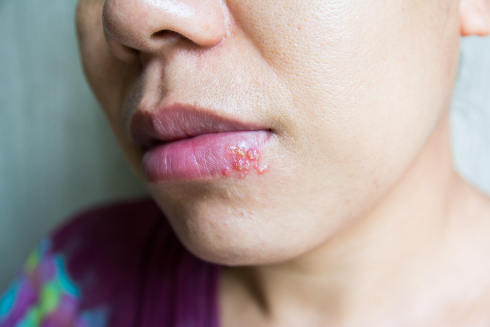 Close up a virus herpes on lips women
