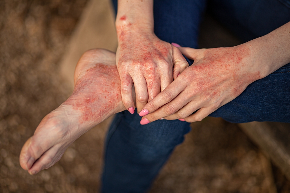 eczema dermatitis on hands and feet. red spots on the skin. dry skin.