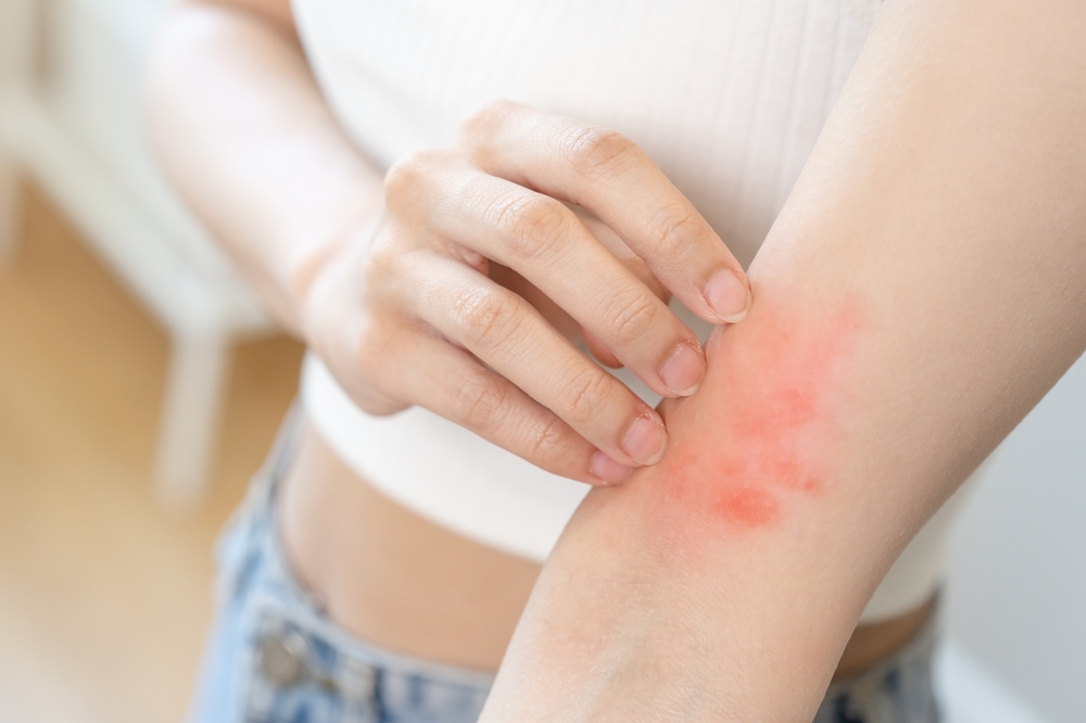 Dermatology asian young woman, girl allergy, allergic reaction from atopic, insect bites on her arm, hand in scratching itchy, itch red spot or rash of skin. Healthcare, treatment of beauty.
