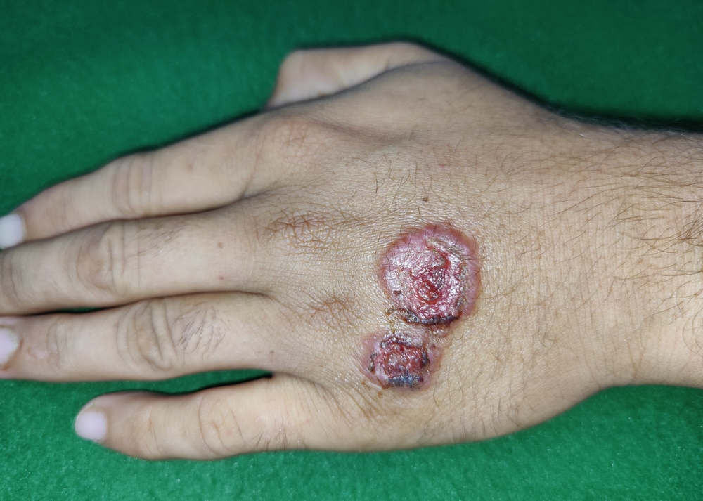 September 11, 2023; Layyah, Punjab, Pakistan: A young boy presented with lesions on dorsum of left hand. These lesions were caused by a disease called leishmaniasis.
