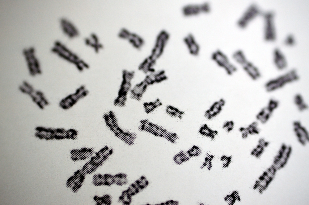Normal female karyotyping, 46 XX, specimen collected from peripheral blood, a karyotype is the general appearance of the complete set of chromosomes in the cells of a species or in an individual organ