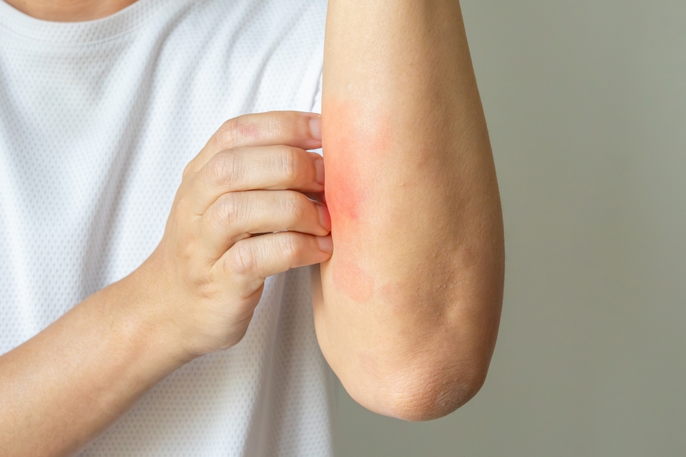Young asian man itching and scratching on arm from allergic itchy dry skin eczema dermatitis insect bites
