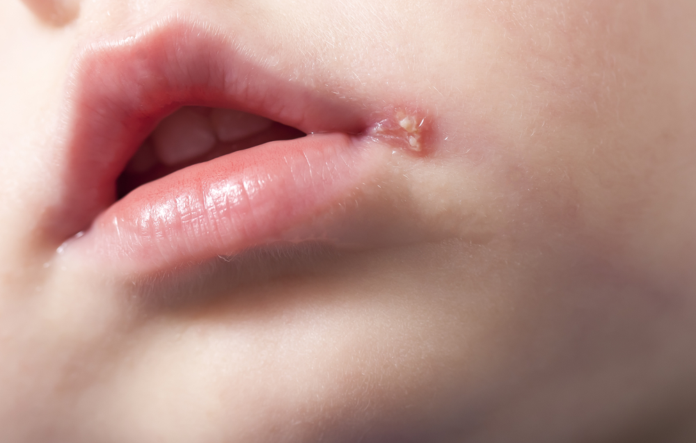 sore on the lip of the child . herpes
