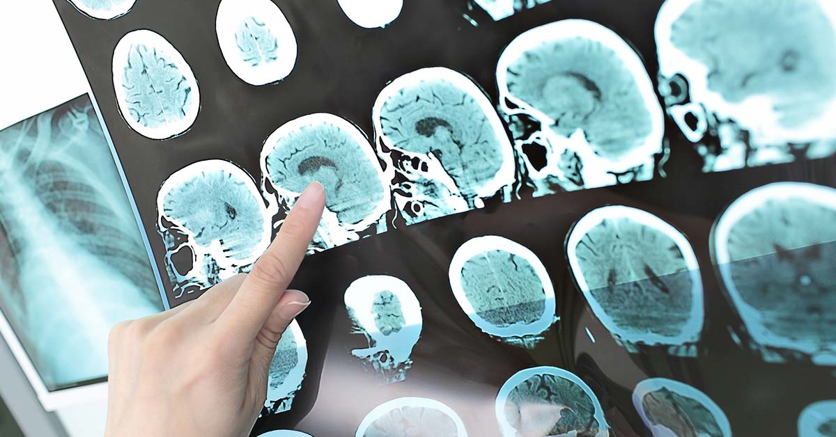 10 Unmistakable Signs Your Body Might Be Sounding the Ischemic Stroke Alarm