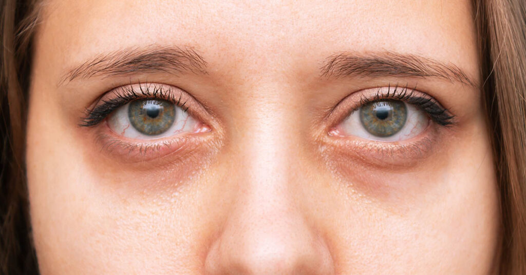8 Reasons For Dark Circles Under The Eyes That Have Nothing to Do With Lack of Sleep - Featured image