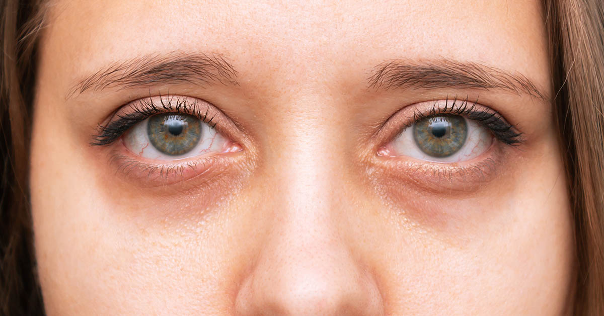 8 Reasons For Dark Circles Under The Eyes That Have Nothing to Do With Lack of Sleep