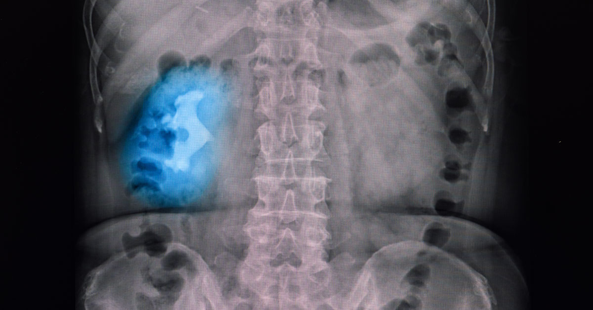 What Are Staghorn Kidney Stones? (Symptoms, Causes, and Treatment) 