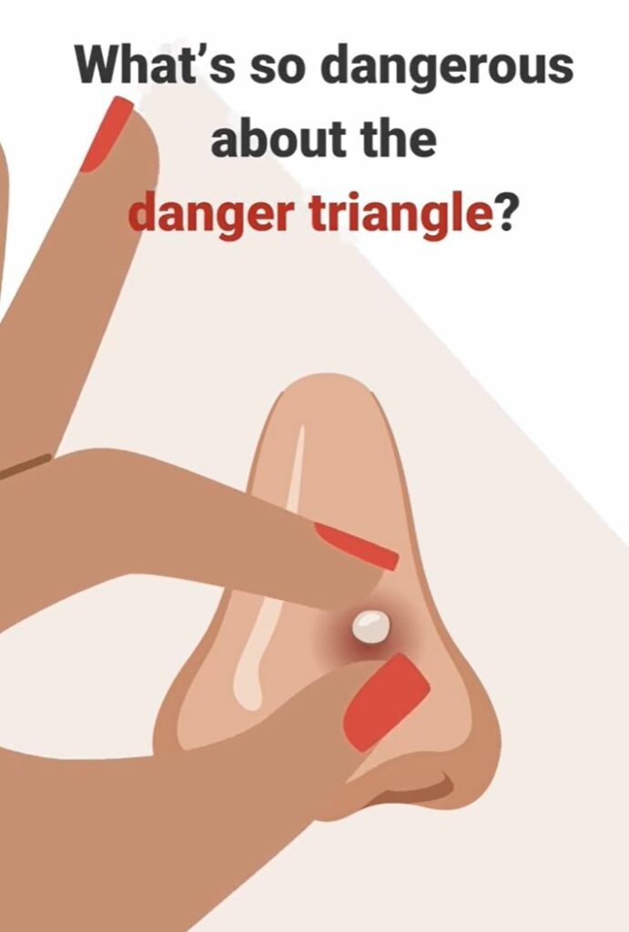 An image of a hand popping a pimple on a nose. 