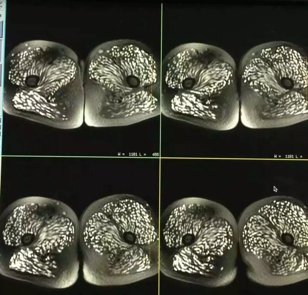 Scans showed parasites all over the woman's body.