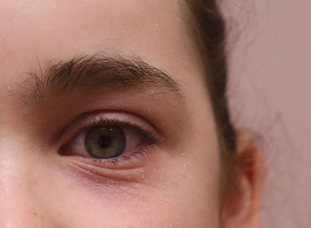 Eyelid eczema atopic dermatitis in an allergic female. There is edema swelling, redness, dry, flaking skin, and Dennie's Lines wrinkles in the lower eyelid.