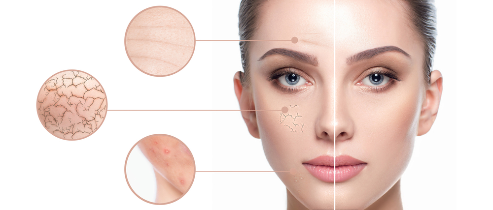 Female face close-up, showing skin problems. Dry skin, acne, wrinkles and other imperfections. Rejuvenation, hydration and skin treatment