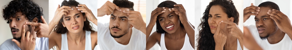 Problem Skin. Diverse Multiethnic People Popping Pimples On Forehead While Standing Near Mirror At Home, Upset Men And Women Inspecting Their Faces, Suffering Acne, Creative Collage