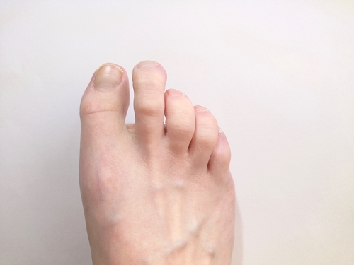 claw toes