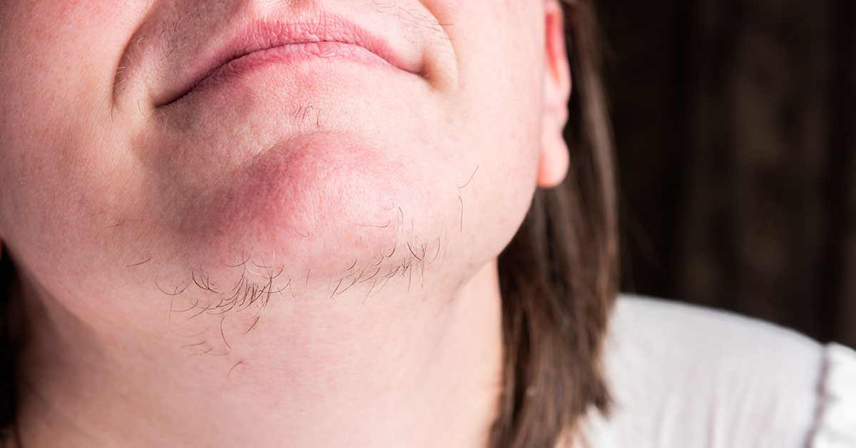 What Causes Excessive Dark Facial and Body Hair Growth in Women?