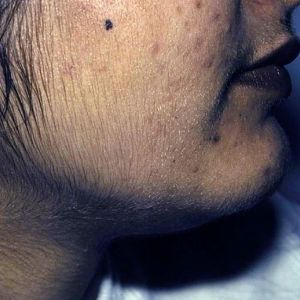 Adrenal Gland Disorders: A Hormonal Imbalance