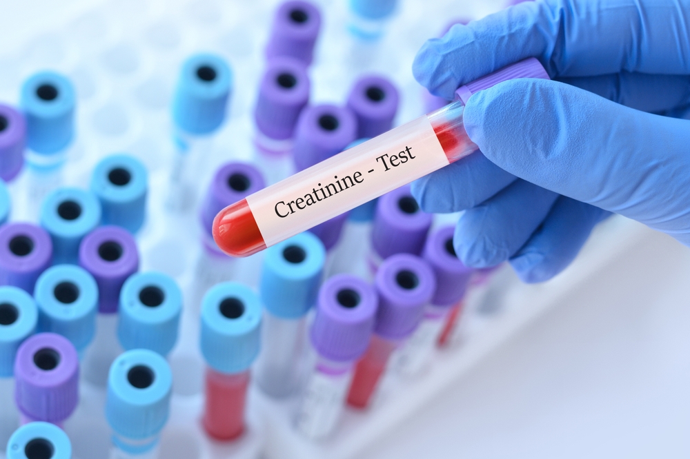 Doctor holding a test blood sample tube with Creatinine test on the background of medical test tubes with analyzes.