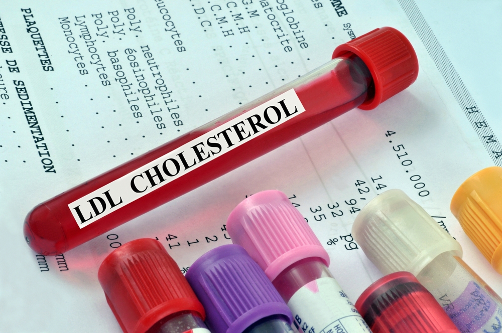Blood tube to test for LDL cholesterol level placed on blood test results

