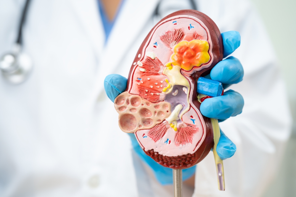 Kidney disease, Chronic kidney disease ckd, Doctor hold human model to treat and study in hospital.