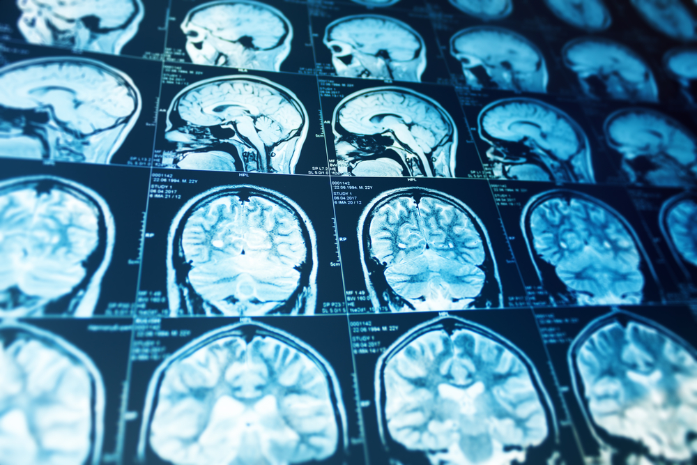 Close up series of a magnetic resonance scan with human head on it. X-ray ct medicine concept