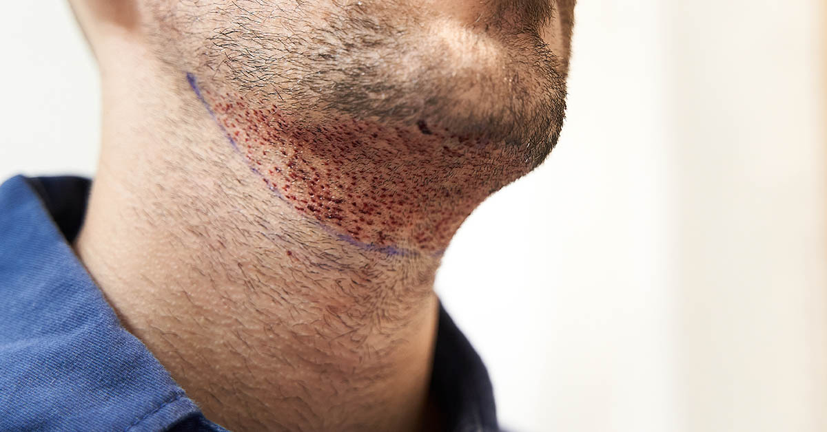 Student took own life after ‘estate agent pretending to be a surgeon’ gave him a beard transplant in Turkey