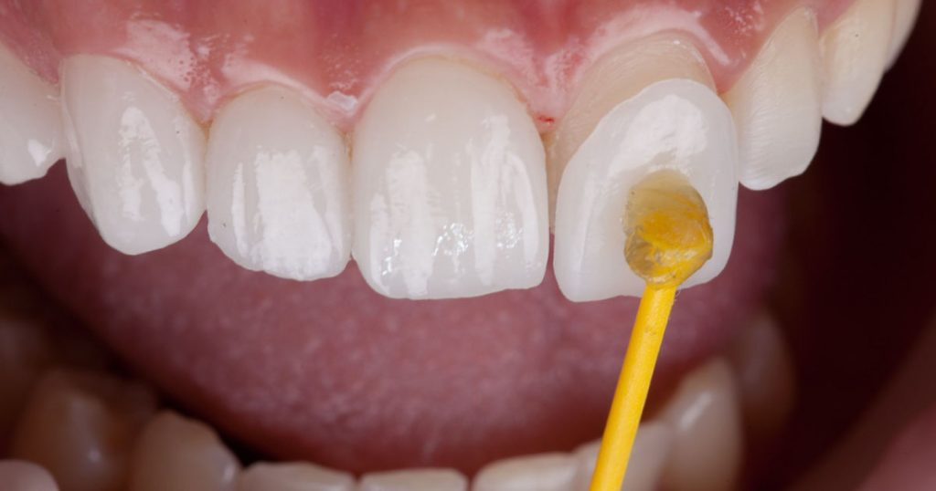 Our ‘Turkey teeth’ cost us $4,800 and look lovely but they’ve ruined our lives’