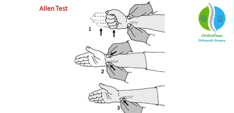 Allen's Test