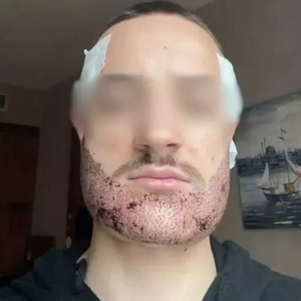 Mathieu suffered from body dysmorphia after being told that some of the operation was irreversible