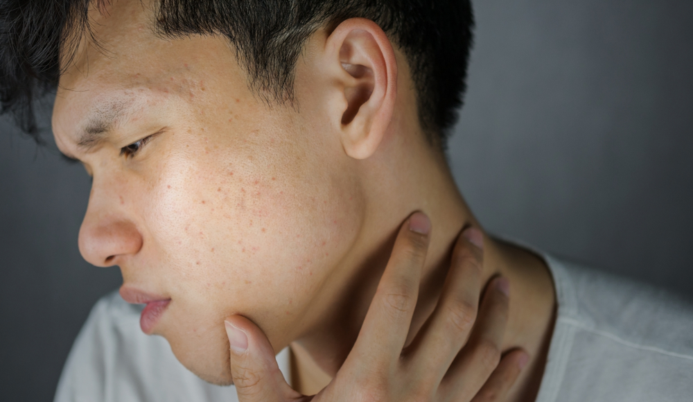 Acne or pimple on looking worried man