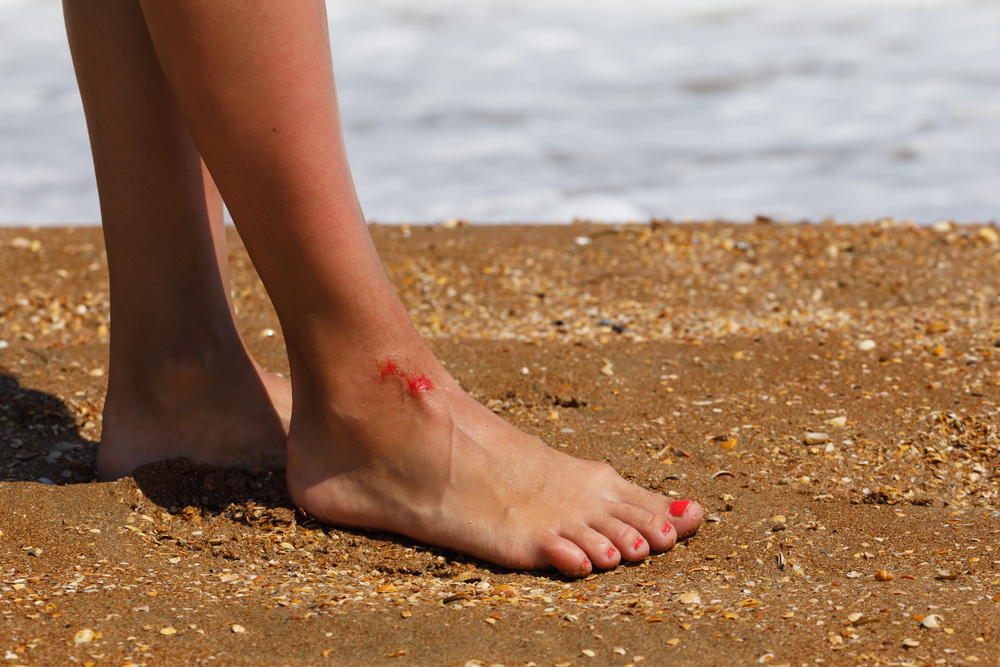 Wound on the leg as a sign of not attentive behavior on the beach
