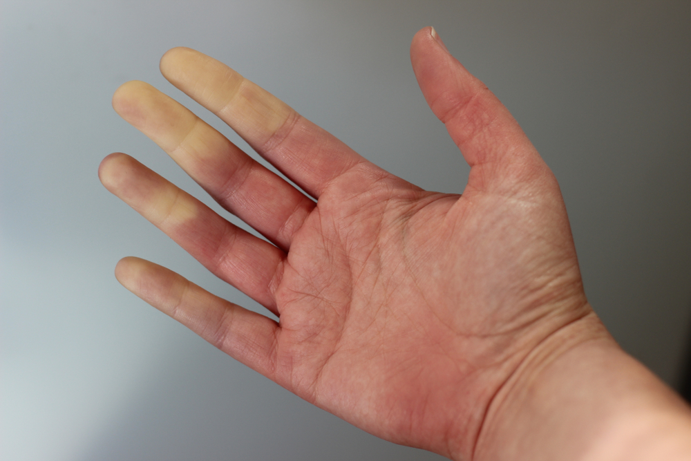 Medical picture of a women hand with raynaulds syndrome.
