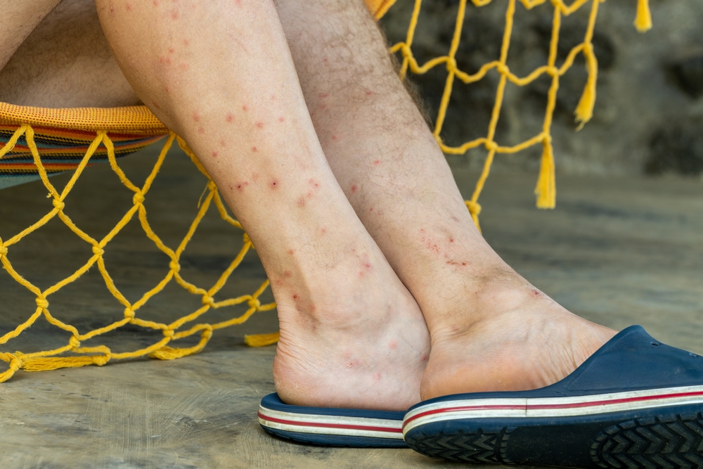 Legs bitten by bloodthirsty insects, Bites of mosquitoes, sandfly, sand fleas or tropical flies called puri puri, The problem of people spending holidays in tropical places