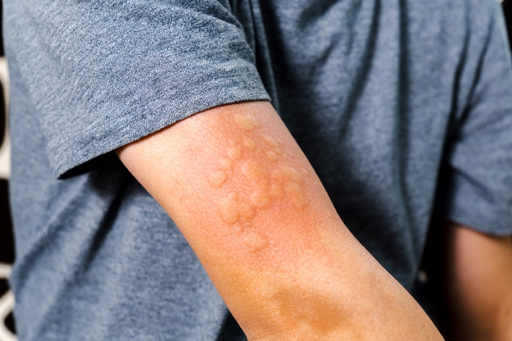 Red rash on skin from allergic reactions. Health care and medical concept, selective focus
