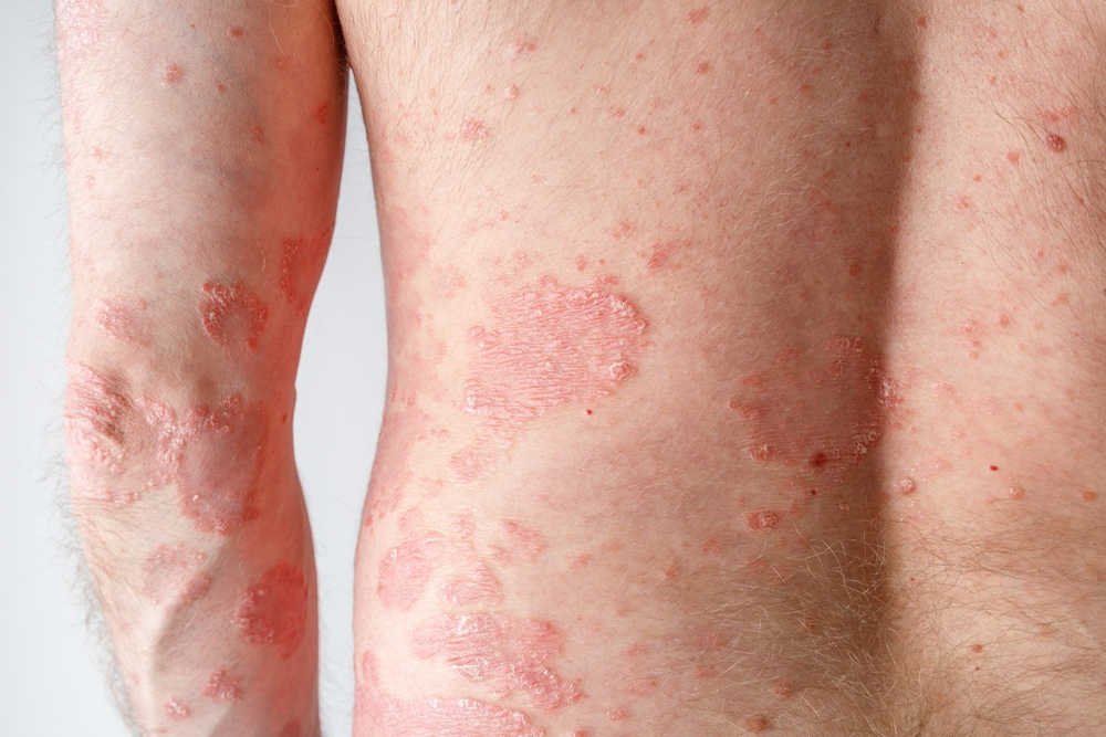 Papules of chronic psoriasis vulgaris on male arm and back body on neutral background. Genetic immune disease.
