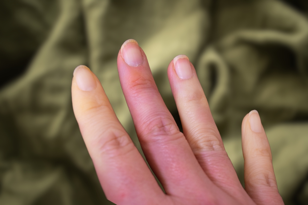 Raynaud's syndrome phenomena Adult hand.
