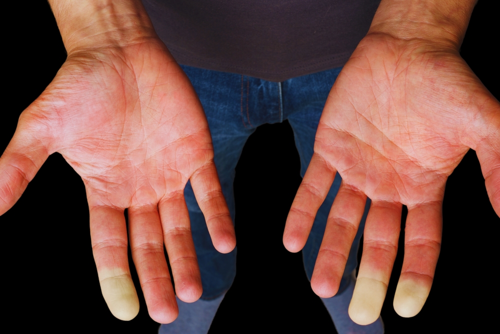 raynauds phenomenon.Raynaud's phenomenon happens when episodes or “attacks” affect certain parts of the body, especially the fingers and toes, causing them to become cold and numb, and change colors
