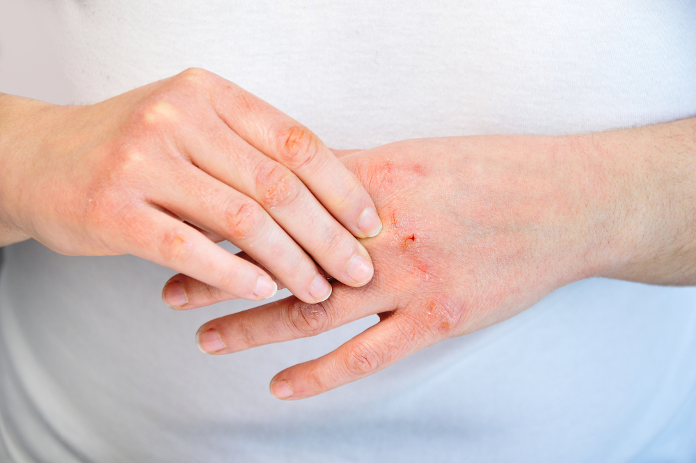 Woman checking the hand with very dry skin and deep cracks
