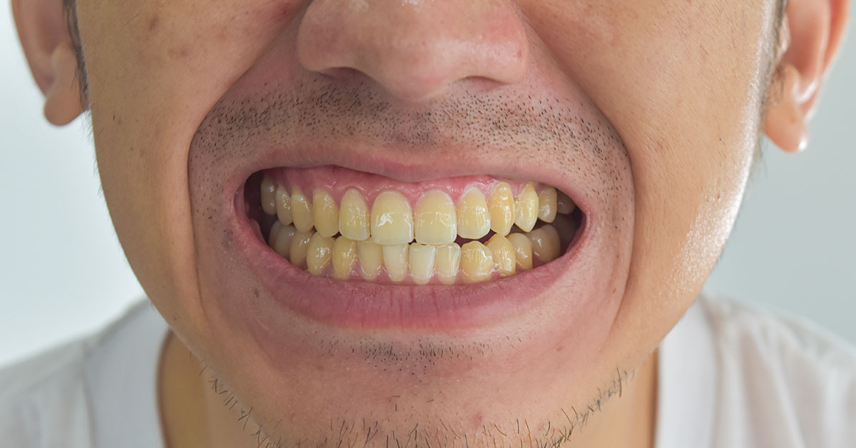 This Popular Drink Could Be Permanently Staining Your Teeth Yellow, Expert Say
