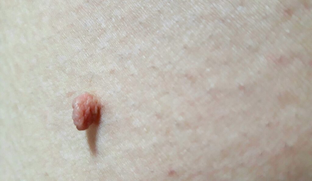 Acrochordon /skin tag