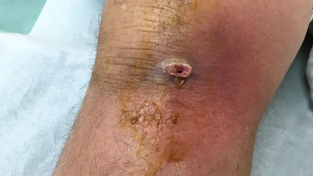 Staf Infection