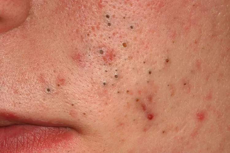 Acne