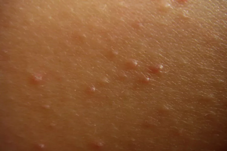Keratosis Pilaris