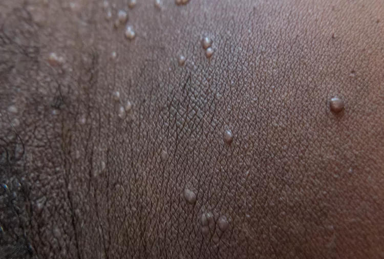 Molluscum Contagiosum
