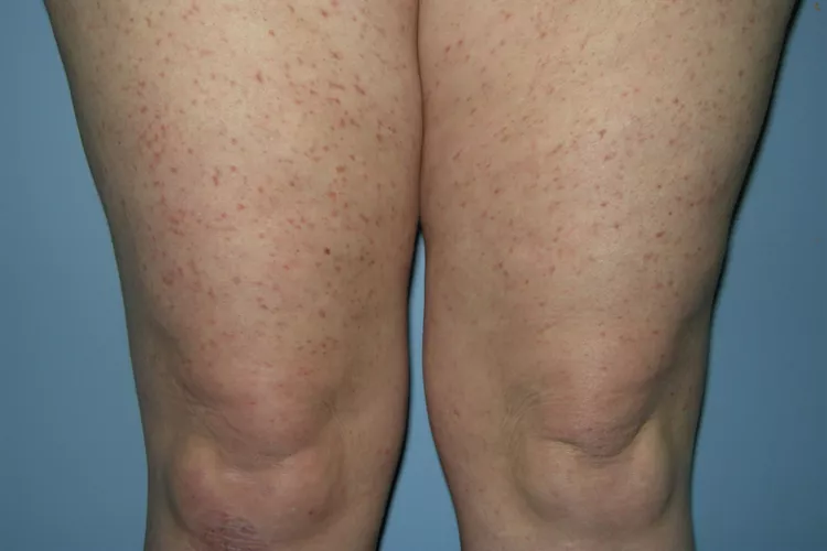 hives on someone's legs