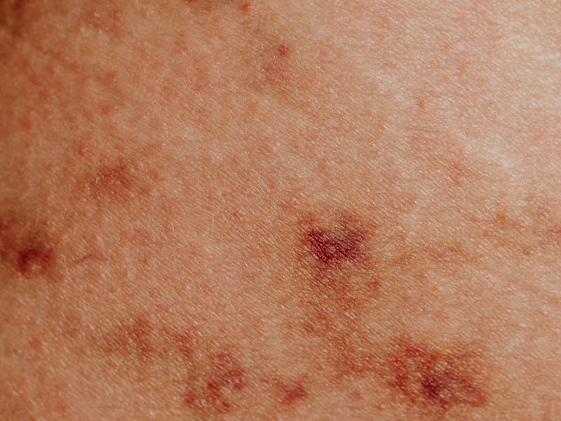 psoriasis