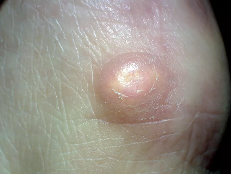 a cyst