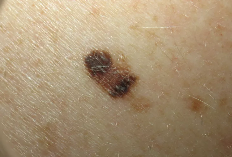 Skin Cancer